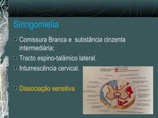 Siringomielia
Comissura Branca e substância cinzenta
intermediária;
Tracto espino-talâmico lateral.
Intumescência cervical.
Dissociação sensitiva
 