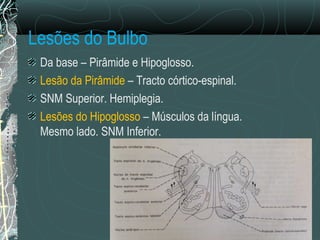 Lesões do Bulbo
Da base – Pirâmide e Hipoglosso.
Lesão da Pirâmide – Tracto córtico-espinal.
SNM Superior. Hemiplegia.
Lesões do Hipoglosso – Músculos da língua.
Mesmo lado. SNM Inferior.
 