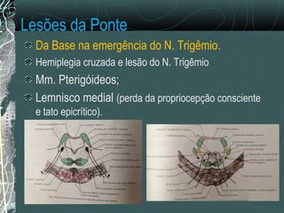 Lesões da Ponte
Da Base na emergência do N. Trigêmio.
Hemiplegia cruzada e lesão do N. Trigêmio
Mm. Pterigóideos;
Lemnisco medial (perda da propriocepção consciente
e tato epicrítico).
 