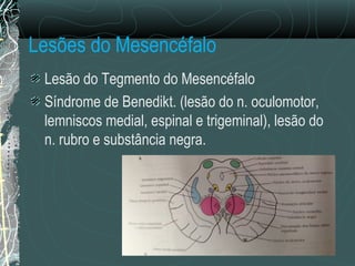 Lesões do Mesencéfalo
Lesão do Tegmento do Mesencéfalo
Síndrome de Benedikt. (lesão do n. oculomotor,
lemniscos medial, espinal e trigeminal), lesão do
n. rubro e substância negra.
 