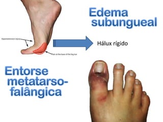 Hálux rígido
 