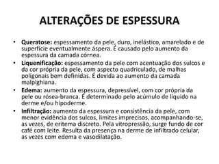 ALTERAÇÕES DE ESPESSURAQueratose: espessamento da pele, duro, inelástico, amarelado e de superfície eventualmente áspera. É causado pelo aumento da espessura da camada córnea.Liquenificação: espessamento da pele com acentuação dos sulcos e da cor própria da pele, com aspecto quadriculado, de malhas poligonais bem definidas. É devida ao aumento da camada malpighiana.Edema: aumento da espessura, depressível, com cor própria da pele ou rósea-branca. É determinado pelo acúmulo de líquido na derme e/ou hipoderme.Infiltração: aumento da espessura e consistência da pele, com menor evidência dos sulcos, limites imprecisos, acompanhando-se, as vezes, de eritema discreto. Pela vitropressão, surge fundo de cor café com leite. Resulta da presença na derme de infiltrado celular, as vezes com edema e vasodilatação.