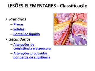 LESÕES ELEMENTARES - ClassificaçãoPrimáriasPlanasSólidasConteúdo líquidoSecundáriasAlterações de consistência e espessuraAlterações produzidas por perda de substância