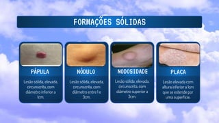 FORMAÇÕES SÓLIDAS
PLACA
Lesão elevada com
altura inferior a 1cm
que se estende por
uma superfície.
Lesão sólida, elevada,
circunscrita, com
diâmetro inferior a
1cm.
Lesão sólida, elevada,
circunscrita, com
diâmetro entre 1 e
3cm.
Lesão sólida, elevada,
circunscrita, com
diâmetro superior a
3cm.
PÁPULA NÓDULO NODOSIDADE
 