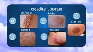 VESÍCULAS BOLHA
PÚSTULA
02
04
COLEÇÕES LÍQUIDAS
ABCESSO
01
03
05
HEMATOMA
 