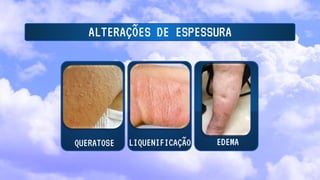 ALTERAÇÕES DE ESPESSURA
QUERATOSE LIQUENIFICAÇÃO EDEMA
 