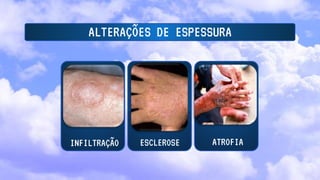 ALTERAÇÕES DE ESPESSURA
INFILTRAÇÃO ESCLEROSE ATROFIA
 