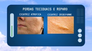 PERDAS TECIDUAIS E REPARO
CICATRIZ ATROFICA CICATRIZ CRIBIFORME
 