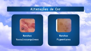 Alterações de Cor
Manchas
Vasculossanguíneas
Manchas
Pigmentares
 