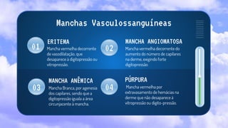 ERITEMA MANCHA ANGIOMATOSA
Mancha vermelha decorrente
de vasodilatação, que
desaparece à digitopressão ou
vitropressão.
Mancha vermelha decorrente do
aumento do número de capilares
na derme, exigindo forte
digitopressão.
Mancha Branca, por agenesia
dos capilares, sendo que a
digitopressão iguala a área
circunjacente à mancha.
Mancha vermelha por
extravasamento de hemácias na
derme que não desaparece à
vitropressão ou digito-pressão.
MANCHA ANÊMICA
02
04
Manchas Vasculossanguíneas
PÚRPURA
01
03
 
