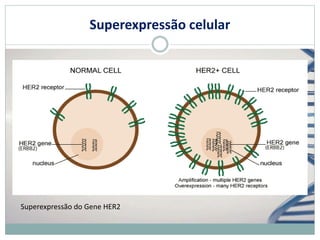 Superexpressão celular
Superexpressão do Gene HER2
 