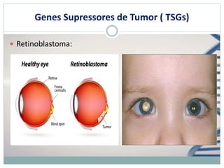 Genes Supressores de Tumor ( TSGs)
 Retinoblastoma:
 