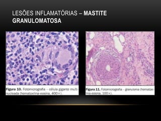 LESÕES INFLAMATÓRIAS – MASTITE
GRANULOMATOSA
 