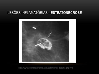 LESÕES INFLAMATÓRIAS - ESTEATONECROSE
http://www.doencadamama.com/tratamento_detalhe.php?i=8
 