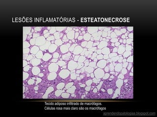 LESÕES INFLAMATÓRIAS - ESTEATONECROSE
aprendendopatologiaa.blogspot.com
Tecido adiposo infiltrado de macrófagos.
Células rosa mais claro são os macrófagos
 