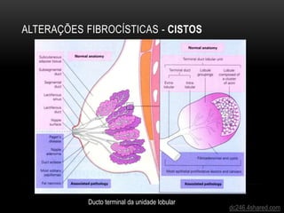 ALTERAÇÕES FIBROCÍSTICAS - CISTOS
dc246.4shared.com
Ducto terminal da unidade lobular
 