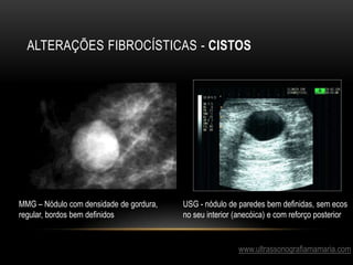 ALTERAÇÕES FIBROCÍSTICAS - CISTOS
www.ultrassonografiamamaria.com
USG - nódulo de paredes bem definidas, sem ecos
no seu interior (anecóica) e com reforço posterior
MMG – Nódulo com densidade de gordura,
regular, bordos bem definidos
 
