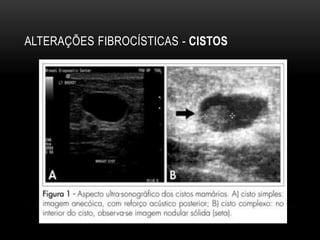 ALTERAÇÕES FIBROCÍSTICAS - CISTOS
 