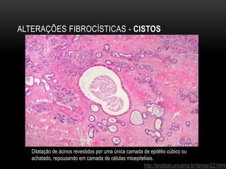 ALTERAÇÕES FIBROCÍSTICAS - CISTOS
http://anatpat.unicamp.br/lamgin22.html
Dilatação de ácinos revestidos por uma única camada de epitélio cúbico ou
achatado, repousando em camada de células mioepiteliais.
 