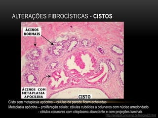 ALTERAÇÕES FIBROCÍSTICAS - CISTOS
http://anatpat.unicamp.br/lamgin22.html
Cisto sem metaplasia apócrina – células da parede ficam achatadas
Metaplasia apócrina – proliferação celular, células cubóides a colunares com núcleo arredondado
- células colunares com citoplasma abundante e com projeções luminais
 