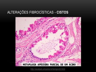 ALTERAÇÕES FIBROCÍSTICAS - CISTOS
http://anatpat.unicamp.br/lamgin22.html
 