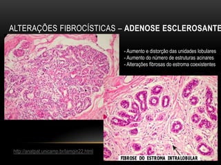 ALTERAÇÕES FIBROCÍSTICAS – ADENOSE ESCLEROSANTE
http://anatpat.unicamp.br/lamgin22.html
- Aumento e distorção das unidades lobulares
- Aumento do número de estruturas acinares
- Alterações fibrosas do estroma coexistentes
 