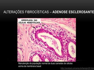 ALTERAÇÕES FIBROCÍSTICAS – ADENOSE ESCLEROSANTE
http://anatpat.unicamp.br/lamgin22.htm
Manutenção da população normal de duas camadas de células
acima da membrana basal
 