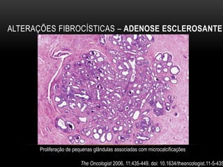 ALTERAÇÕES FIBROCÍSTICAS – ADENOSE ESCLEROSANTE
The Oncologist 2006, 11:435-449. doi: 10.1634/theoncologist.11-5-435
Proliferação de pequenas glândulas associadas com microcalcificações
 