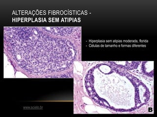 ALTERAÇÕES FIBROCÍSTICAS -
HIPERPLASIA SEM ATIPIAS
www.scielo.br
- Hiperplasia sem atipias moderada, florida
- Células de tamanho e formas diferentes
 