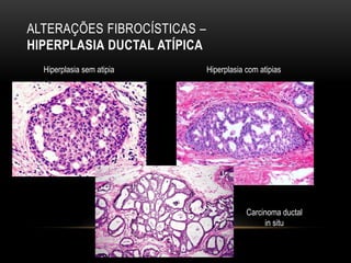 ALTERAÇÕES FIBROCÍSTICAS –
HIPERPLASIA DUCTAL ATÍPICA
Hiperplasia sem atipia Hiperplasia com atipias
Carcinoma ductal
in situ
 