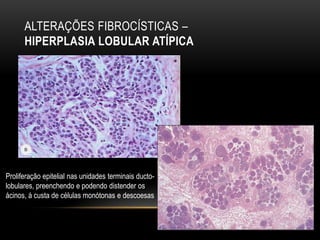 ALTERAÇÕES FIBROCÍSTICAS –
HIPERPLASIA LOBULAR ATÍPICA
Proliferação epitelial nas unidades terminais ducto-
lobulares, preenchendo e podendo distender os
ácinos, á custa de células monótonas e descoesas
 