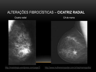 ALTERAÇÕES FIBROCÍSTICAS – CICATRIZ RADIAL
http://mastologia.wordpress.com/page/3
Cicatriz radial CA de mama
http://www.mulheresnopoder.com.br/tag/mamografia/
 