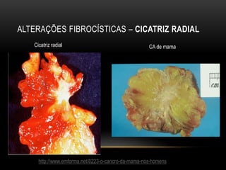 ALTERAÇÕES FIBROCÍSTICAS – CICATRIZ RADIAL
Cicatriz radial CA de mama
http://www.emforma.net/8223-o-cancro-da-mama-nos-homens
 