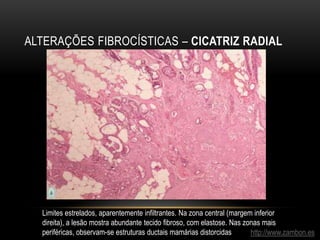 ALTERAÇÕES FIBROCÍSTICAS – CICATRIZ RADIAL
http://www.zambon.es
Limites estrelados, aparentemente infiltrantes. Na zona central (margem inferior
direita), a lesão mostra abundante tecido fibroso, com elastose. Nas zonas mais
periféricas, observam-se estruturas ductais mamárias distorcidas
 