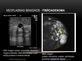 NEOPLASMAS BENIGNOS - FIBROADENOMA
demos.biemedia.com talkativebrain.blogspot.com
- USG: imagem nodular, circunscrita, hipoecóica,
margens definidas, maior eixo paralelo á pele,
reforço posterior e sombras laterais
MMG: imagem
nodular, circunscrita, ovalada, calcificações
grosseiras, aspecto de “pipoca”
 
