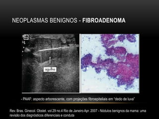 NEOPLASMAS BENIGNOS - FIBROADENOMA
Rev. Bras. Ginecol. Obstet. vol.29 no.4 Rio de Janeiro Apr. 2007 - Nódulos benignos da mama: uma
revisão dos diagnósticos diferenciais e conduta
- PAAF: aspecto arborescente, com projeções fibroepiteliais em “dedo de luva”
 