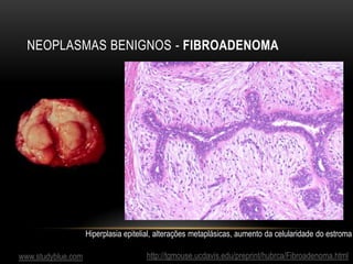 NEOPLASMAS BENIGNOS - FIBROADENOMA
http://tgmouse.ucdavis.edu/preprint/hubrca/Fibroadenoma.html
Hiperplasia epitelial, alterações metaplásicas, aumento da celularidade do estroma
www.studyblue.com
 