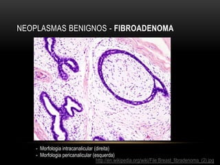 NEOPLASMAS BENIGNOS - FIBROADENOMA
http://en.wikipedia.org/wiki/File:Breast_fibradenoma_(2).jpg
- Morfologia intracanalicular (direita)
- Morfologia pericanalicular (esquerda)
 