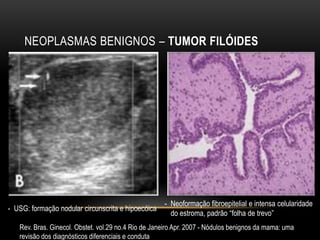 NEOPLASMAS BENIGNOS – TUMOR FILÓIDES
Rev. Bras. Ginecol. Obstet. vol.29 no.4 Rio de Janeiro Apr. 2007 - Nódulos benignos da mama: uma
revisão dos diagnósticos diferenciais e conduta
- USG: formação nodular circunscrita e hipoecóica
- Neoformação fibroepitelial e intensa celularidade
do estroma, padrão “folha de trevo”
 