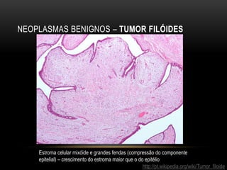 NEOPLASMAS BENIGNOS – TUMOR FILÓIDES
http://pt.wikipedia.org/wiki/Tumor_filoide
Estroma celular mixóide e grandes fendas (compressão do componente
epitelial) – crescimento do estroma maior que o do epitélio
 