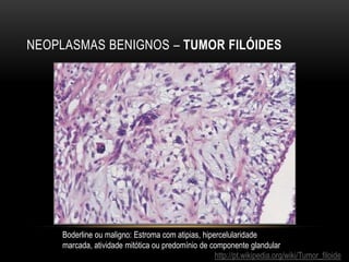 NEOPLASMAS BENIGNOS – TUMOR FILÓIDES
http://pt.wikipedia.org/wiki/Tumor_filoide
Boderline ou maligno: Estroma com atipias, hipercelularidade
marcada, atividade mitótica ou predomínio de componente glandular
 