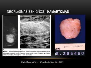 NEOPLASMAS BENIGNOS - HAMARTOMAS
Radiol Bras vol.38 no.5 São Paulo Sept./Oct. 2005
 