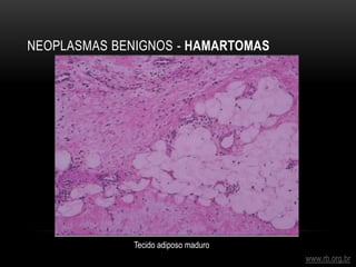NEOPLASMAS BENIGNOS - HAMARTOMAS
www.rb.org.br
Tecido adiposo maduro
 
