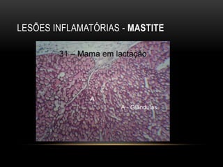 LESÕES INFLAMATÓRIAS - MASTITE
 