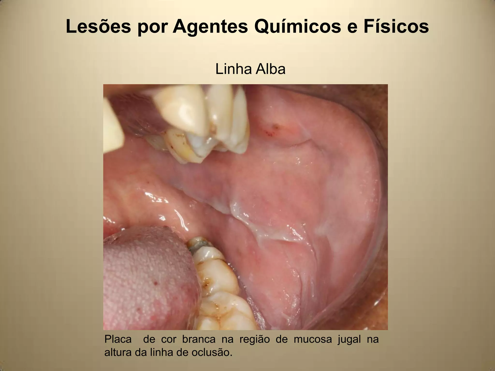 Lesões por Agentes Químicos e Físicos
Linha Alba
Placa de cor branca na região de mucosa jugal na
altura da linha de oclusão.