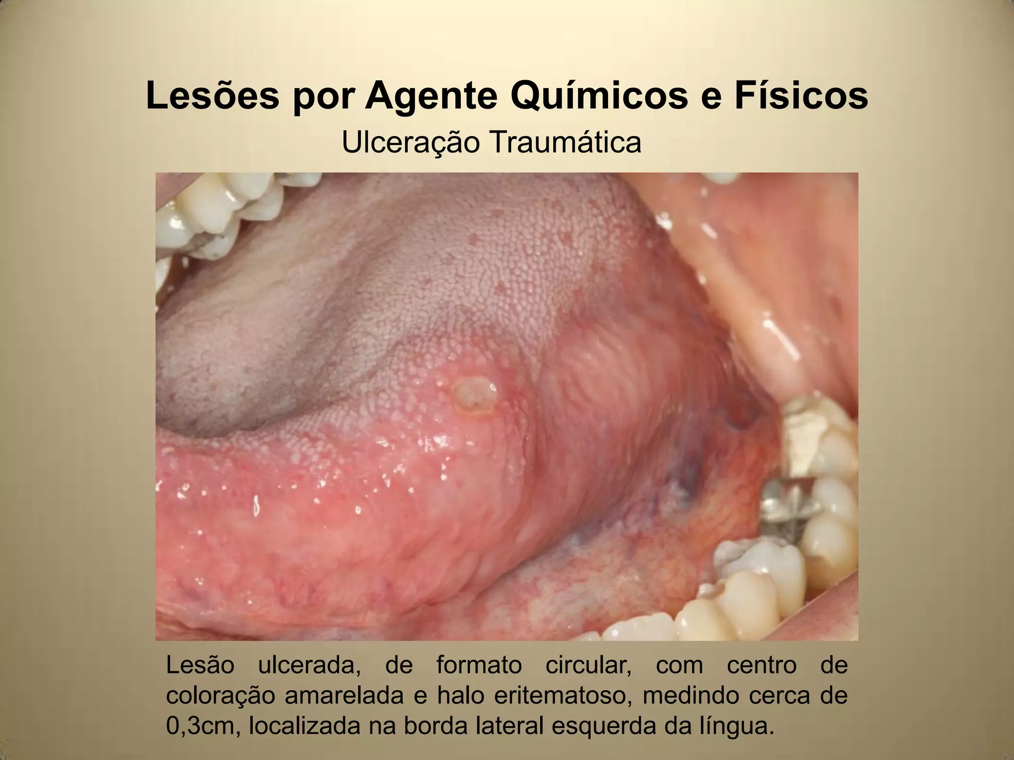 Lesões por Agente Químicos e Físicos
Ulceração Traumática
Lesão ulcerada, de formato circular, com centro de
coloração amarelada e halo eritematoso, medindo cerca de
0,3cm, localizada na borda lateral esquerda da língua.