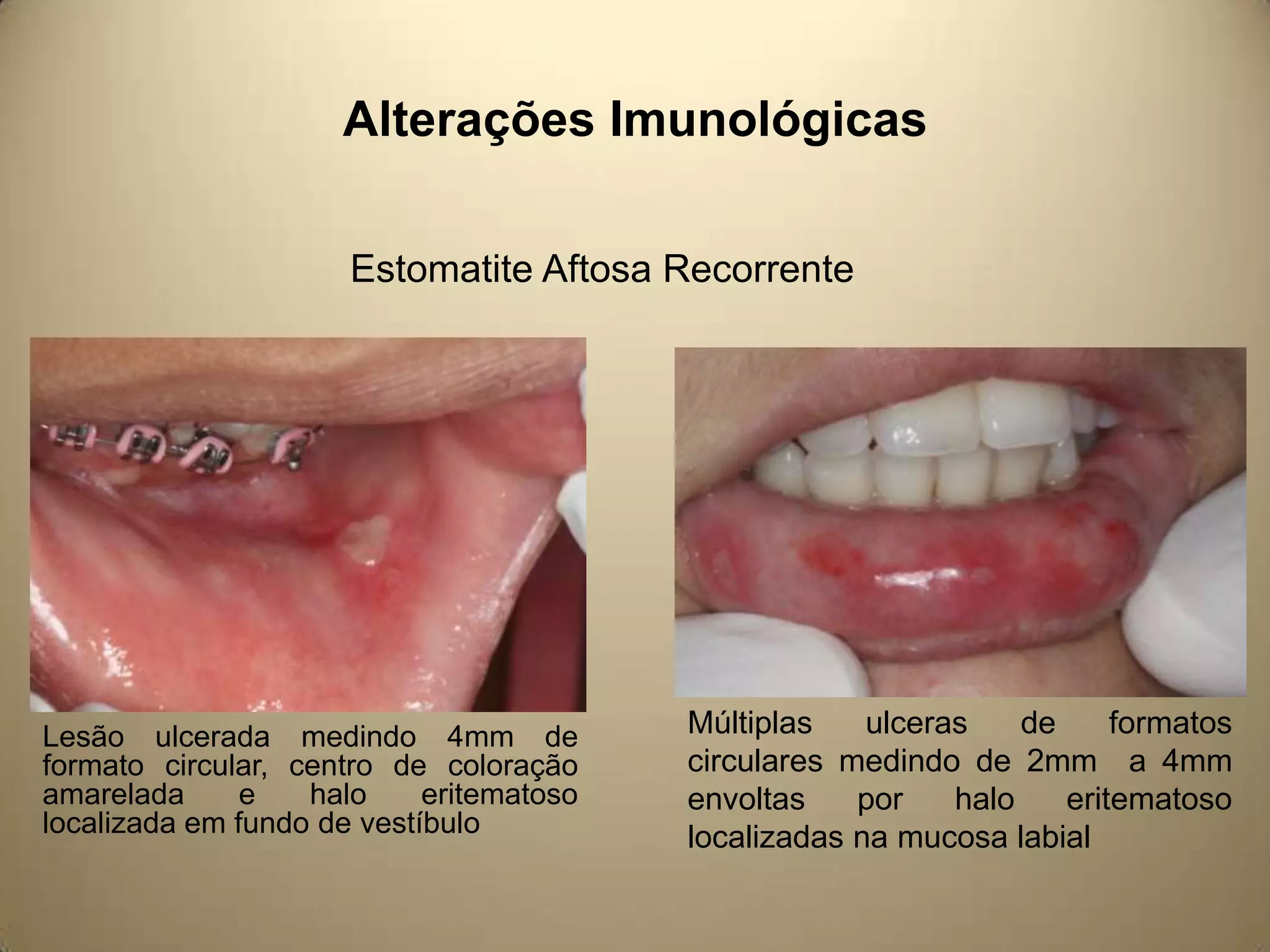 Alterações Imunológicas
Estomatite Aftosa Recorrente
Lesão ulcerada medindo 4mm de
formato circular, centro de coloração
amarelada
e
halo
eritematoso
localizada em fundo de vestíbulo
Múltiplas
ulceras
de
formatos
circulares medindo de 2mm a 4mm
envoltas
por
halo
eritematoso
localizadas na mucosa labial