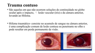 Trauma contuso
• São aquelas em que não ocorrem soluções de continuidade no globo
ocular após o impacto,  lesão vascular (iris) e da câmara anterior,
levando ao Hifema.
• Hifema traumático- consiste no acumulo de sangue na câmara anterior,
é uma complicação comum de lesão contusa ou penetrante no olho e
pode resultar em perda permanente da visão.
 