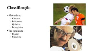 Classificação
• Mecanismo
• Contuso
• Perfurante
• Químico
• Iatrogénico
• Profundidade
• Parcial
• Completa
 