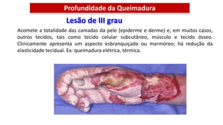 Lesão de III grau
Acomete a totalidade das camadas da pele (epiderme e derme) e, em muitos casos,
outros tecidos, tais como tecido celular subcutâneo, músculo e tecido ósseo.
Clinicamente apresenta um aspecto esbranquiçado ou marmóreo; há redução da
elasticidade tecidual. Ex: queimadura elétrica, térmica.
Profundidade da Queimadura
 